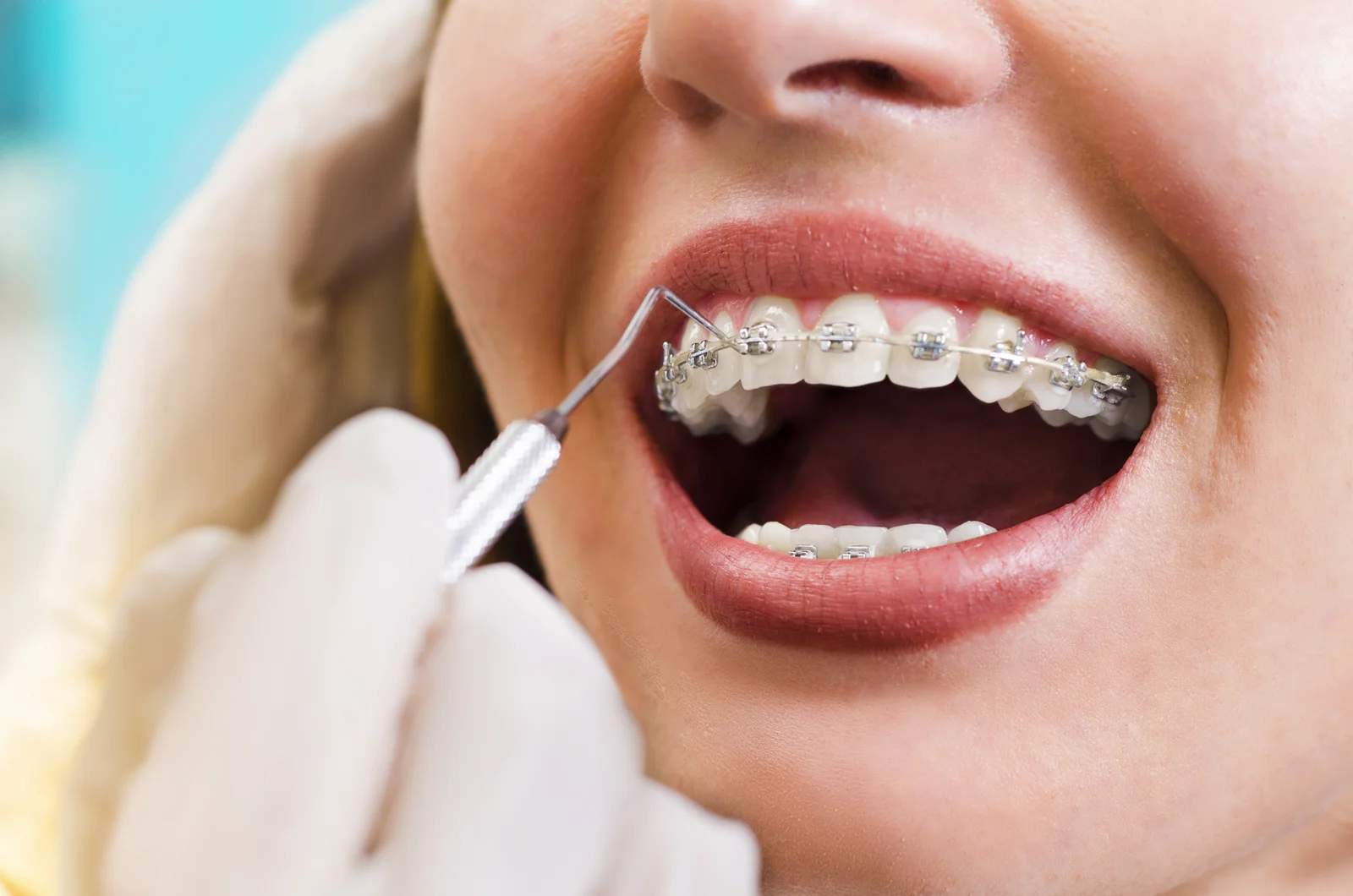 Braces and aligners treatment in Karachi