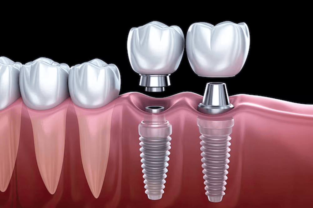 Dental implant treatment in Karachi