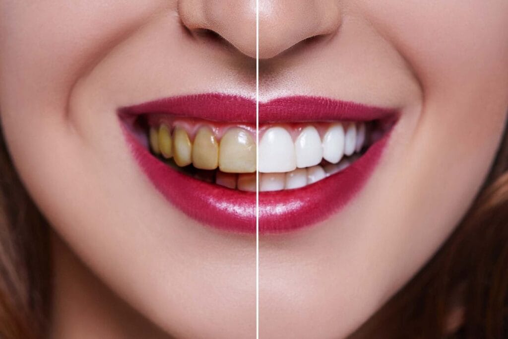Teeth whitening service at Ozair Dental Clinic